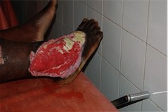 Infected wound - Malawi